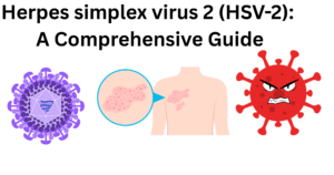 Herpes simplex Virus 2 (HSV-2)