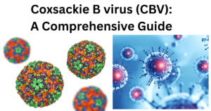 _Coxsackie B virus (CBV)